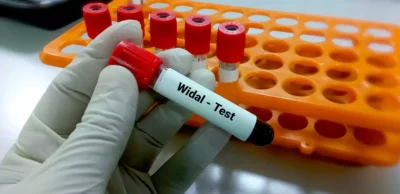Widal Test