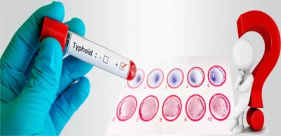 Typhoid Test