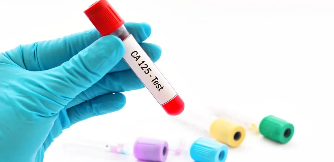 CA-125 Test