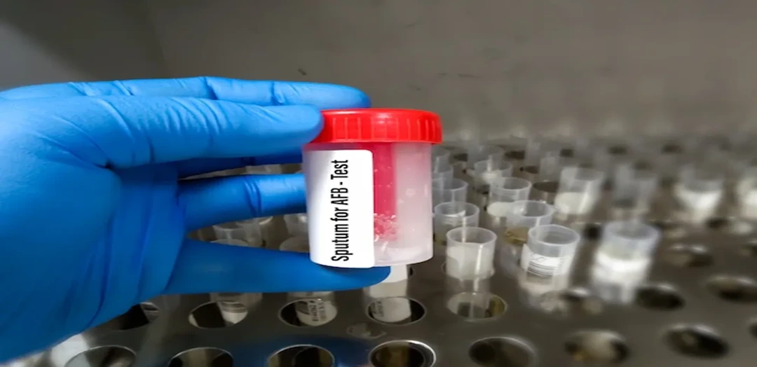 Sputum / AFB Test – Acid Fast Bacilli