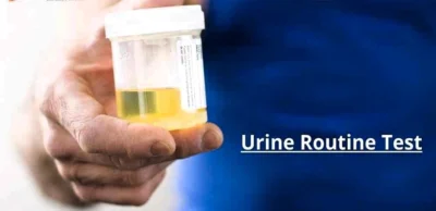 Urine Routine Test (RUA – Routine Urine Analysis)