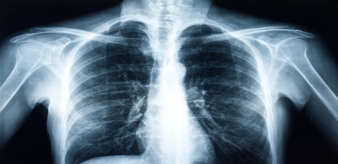 Chest PA View X-Ray Test (Posterior Anterior View)