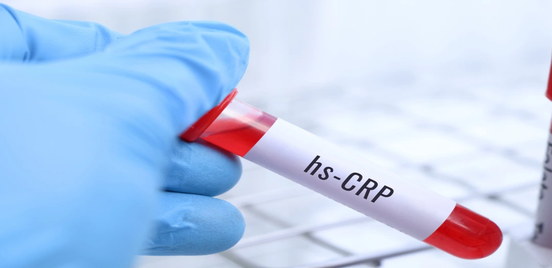 High Sensitive C-Reactive Protein (hs-CRP) Test