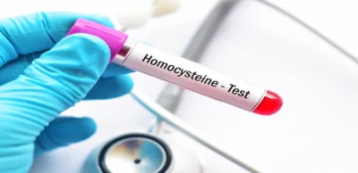 Homocysteine Blood Test