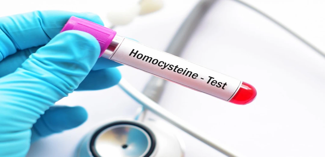 Homocysteine Blood Test