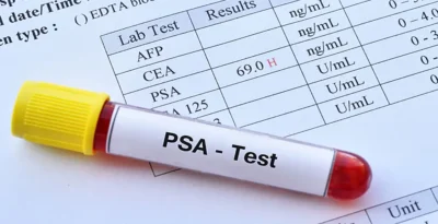 Prostate Specific Antigen (PSA) Test