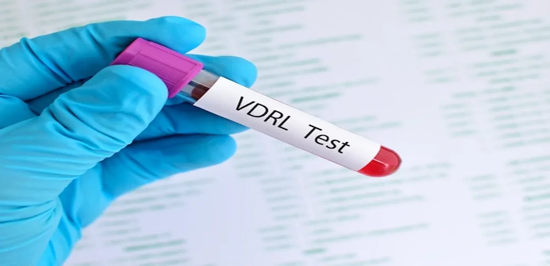 VDRL (Veneral Disease Research Laboratory) Test