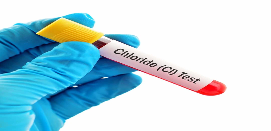 Chloride Blood Test