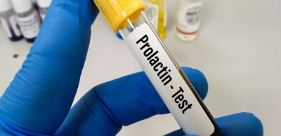Prolactin Test
