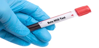 Beta HCG (B-HCG) Test